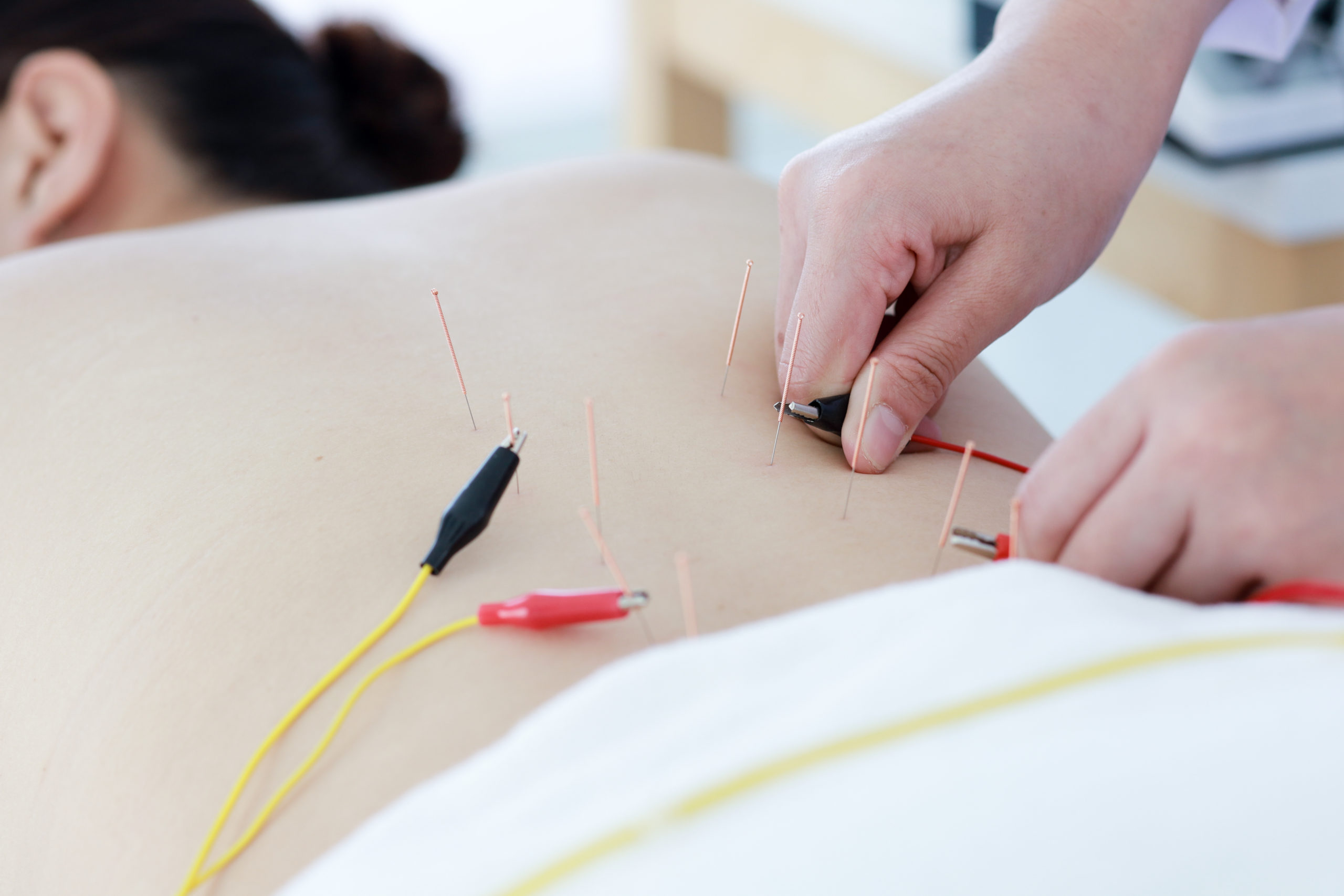 Why study Neuropuncture, neuroscience electroacupuncture