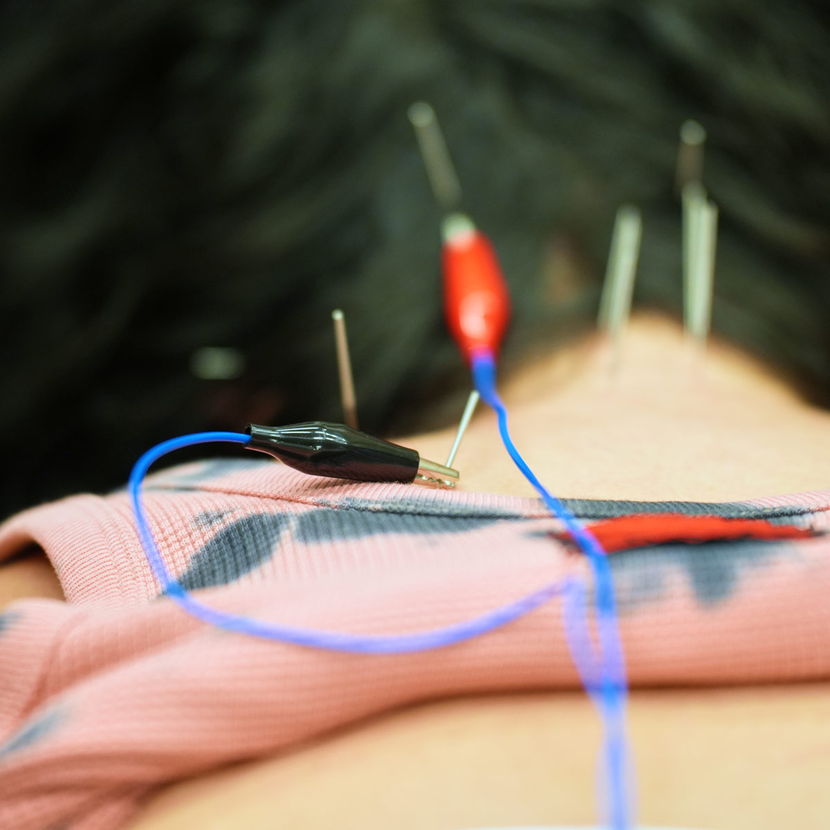 Learn acupuncture protocols for cervical pain and orthopedic conditions