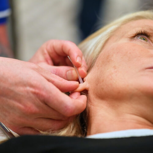 Neuropuncture neuroscience acupuncture for mental health conditions