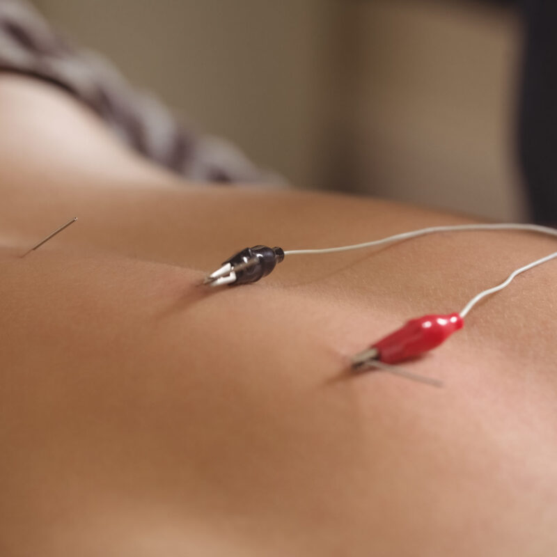 Neuropuncture electro-acupuncture neuromodulation