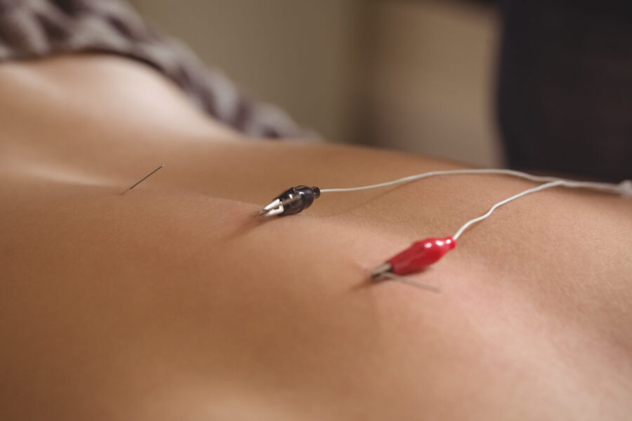 Neuropuncture electro-acupuncture neuromodulation